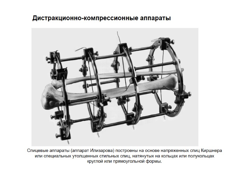 Дистракционно-компрессионные аппараты Спицевые аппараты (аппарат Илизарова) построены на основе напряженных спиц Киршнера или специальных